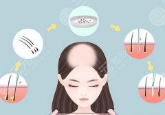 正规医院植发一般多少钱?需要注意什么?