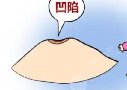 乳头内陷