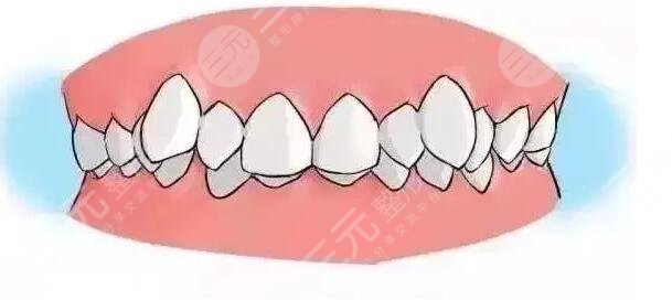 牙齿矫正