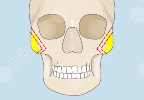 上海九院颧骨内推医生 