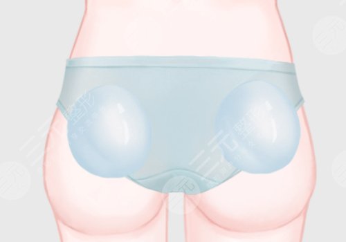 上海第九人民医院假体丰臀的医生有哪些?