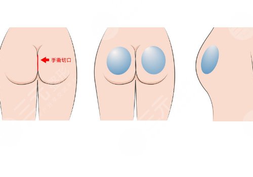 上海第九人民医院假体丰臀的医生有哪些?