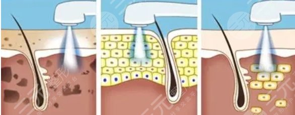 安徽医科大学第一附属医院整形科疤痕去除案例