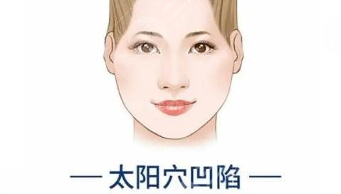 太阳穴凹陷