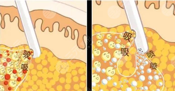 抽脂肚子