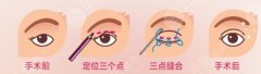 双眼皮多久可以做修复手术？4种不同情况时间不同！科普来了~