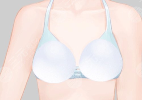 乳房假体取出后要束胸吗