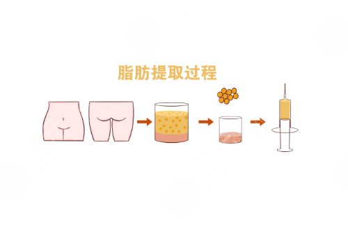 自体脂肪丰胸手术费大概要多少钱