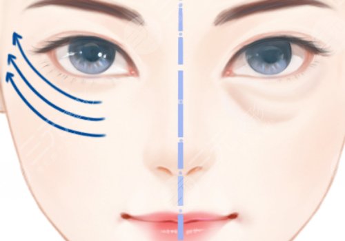 上海九院做眼袋手术多少钱 