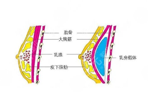 张海林医生隆胸怎么样