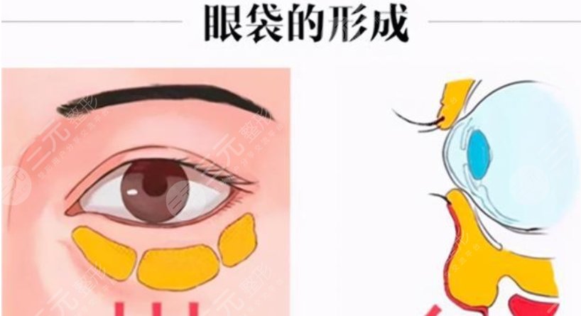 芜湖第二人民医院去眼袋案例