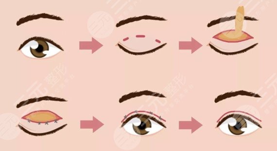 北京八大处林琳医生简介！双眼皮风格你喜欢吗？案例、费用分享~