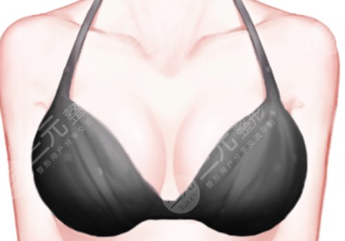 上海九医院徐华和王涛乳房再造哪个好