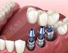 登腾种植牙有几种价格？参考价格为4000元起，附种植牙信息一览