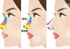 哈尔滨假体隆鼻一般多少钱?硅胶隆鼻1.7万元起\软骨隆鼻1.6万元起! 哈尔滨假体隆鼻一般多少钱?硅胶隆鼻1.7万元起\软骨隆鼻1.6万元起!