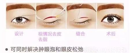 郑州电力何永强双眼皮怎么样？医生技术力介绍、美眼日记汇总！