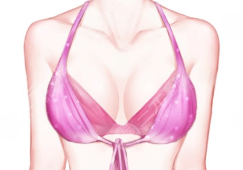 乳房切除后做假体隆胸安全吗
