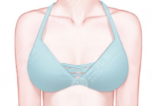 乳房切除后做假体隆胸安全吗