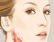 面部疤痕整形手术费用是多少？如何选择合适的医院？参考价格为5000元起