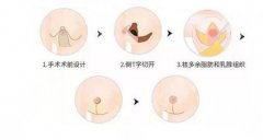 缩胸手术风险大吗会危及生命吗?什么年龄段适合做? 缩胸手术风险大吗会危及生命吗?什么年龄段适合做?