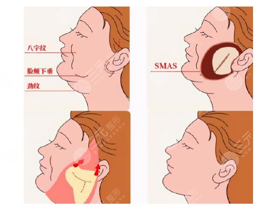 徐国建医生拉皮手术费用是多少