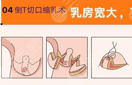巨乳缩小