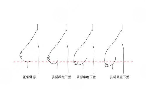 隆胸悬吊的效果好吗