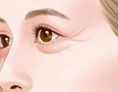 眼角除皱手术多少钱？参考价格为在2000元起_注意事项分享