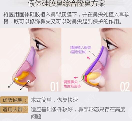 张明兴个人资料及图片案例分享，广州华美热门医生，隆鼻好评多！