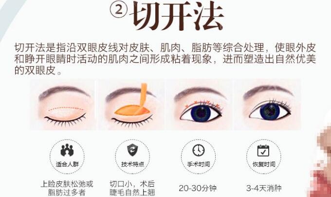 徐逸医生双眼皮手术