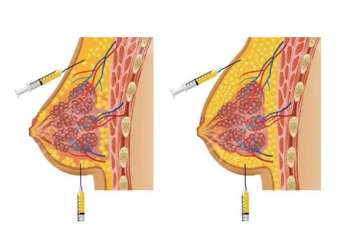 栾芳医生隆胸怎么样