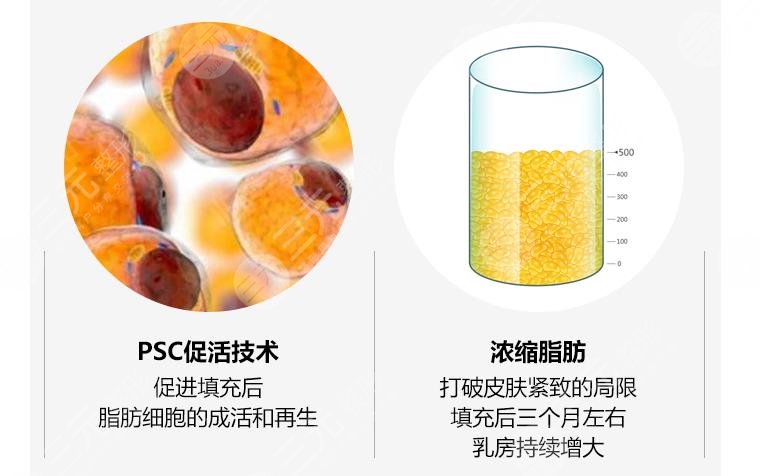 自体脂肪丰胸可靠吗