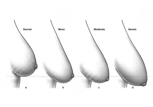 胸下垂外扩有什么办法能挺起来