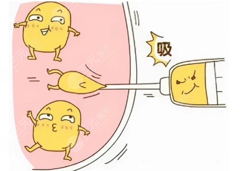 郑博晨医生抽脂案例