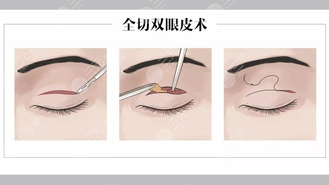 合肥李小静双眼皮案例分享！安医附院整形实力派，医生风格揭秘~