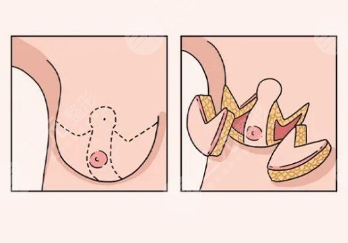 珠江医院缩胸多少钱