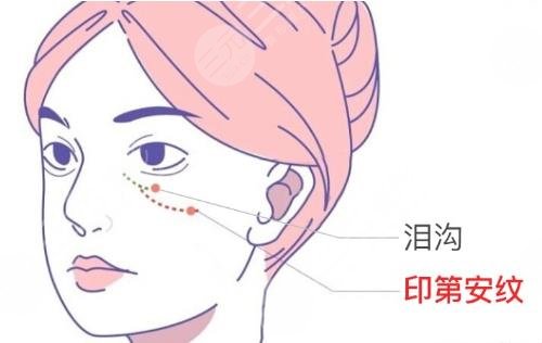 熊猫针和胶原蛋白哪个填充泪沟好?两者区别是什么? 熊猫针和胶原蛋白哪个填充泪沟好?两者区别是什么?