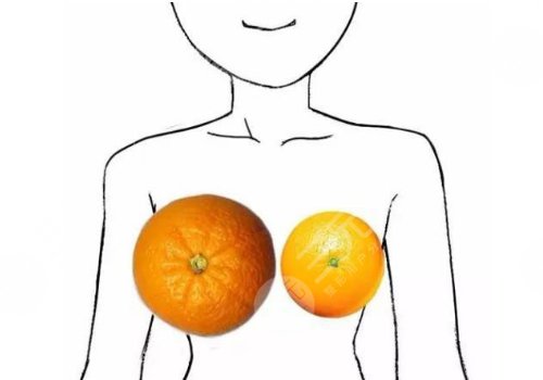 徐医附院缩胸手术费用