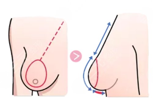 徐医附院缩胸手术费用