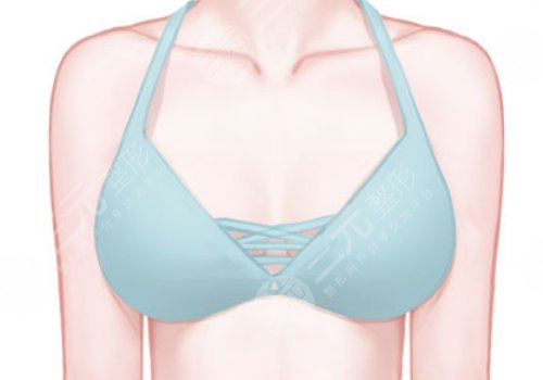 南医三院缩胸手术费用