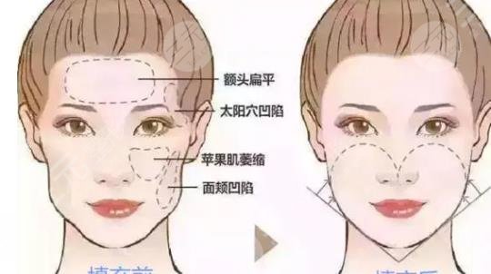 脂肪填充