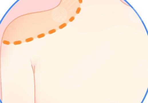 背部吸脂