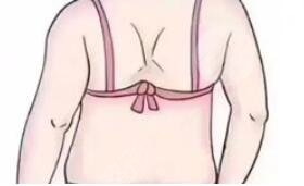 背部吸脂