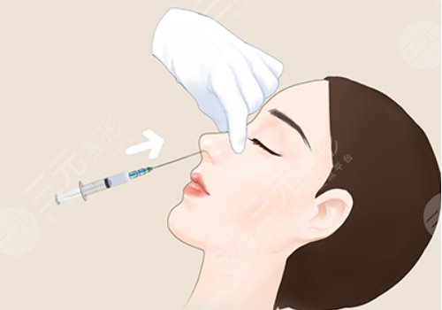 爱贝芙适合打鼻梁吗?注射前需要注意什么? 爱贝芙适合打鼻梁吗?注射前需要注意什么?