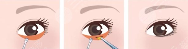 眶隔释放