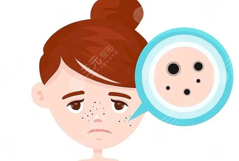 李晓阳医生激光祛斑案例