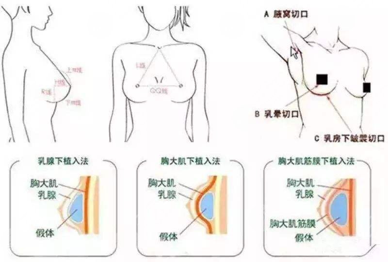 双平面隆胸从哪里切口
