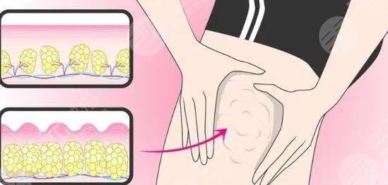 吸脂技术