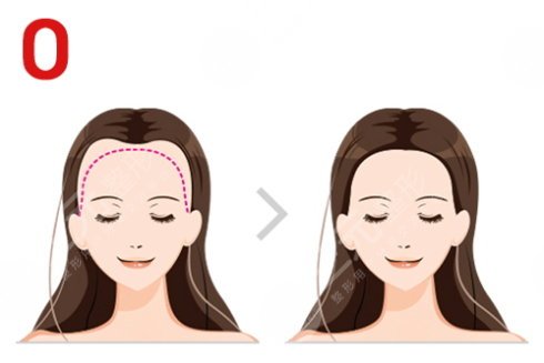 6000元植发面积是多少