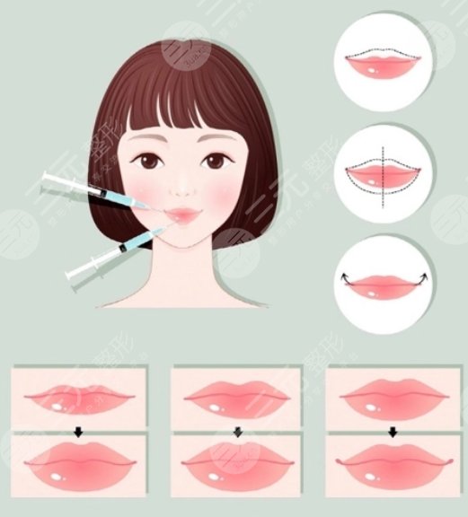 蒋萱医生做唇案例